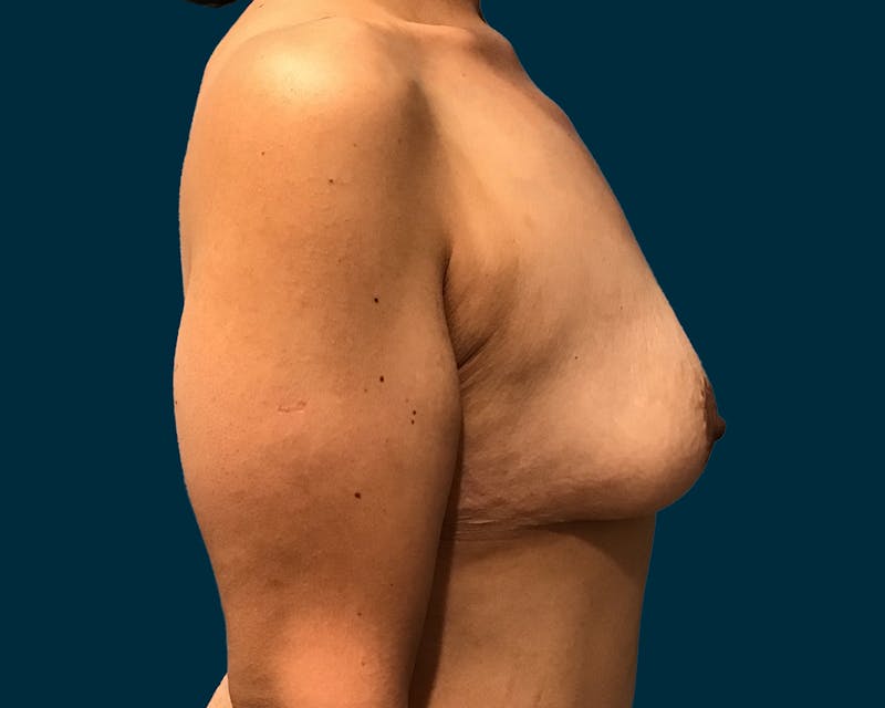 Breast Lift Before & After Gallery - Patient 875162 - Image 5