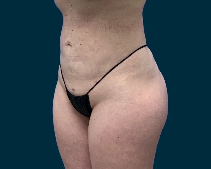 Liposuction Before & After Gallery - Patient 308096 - Image 2