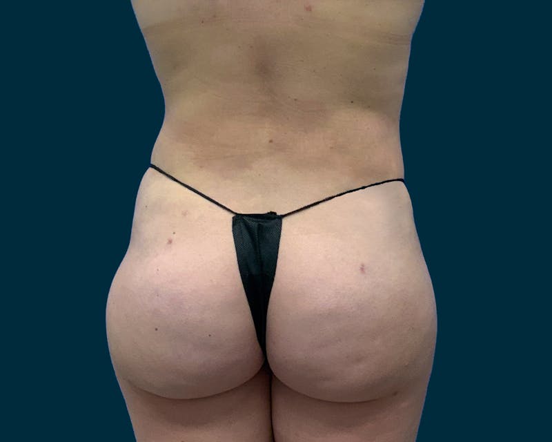 Fat Transfer Before & After Gallery - Patient 305664 - Image 4