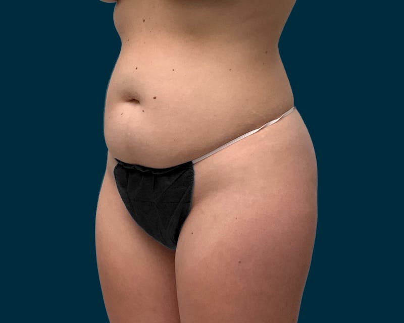 Fat Transfer Before & After Gallery - Patient 305664 - Image 1