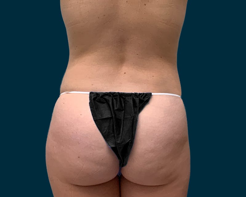 Fat Transfer Before & After Gallery - Patient 305664 - Image 3