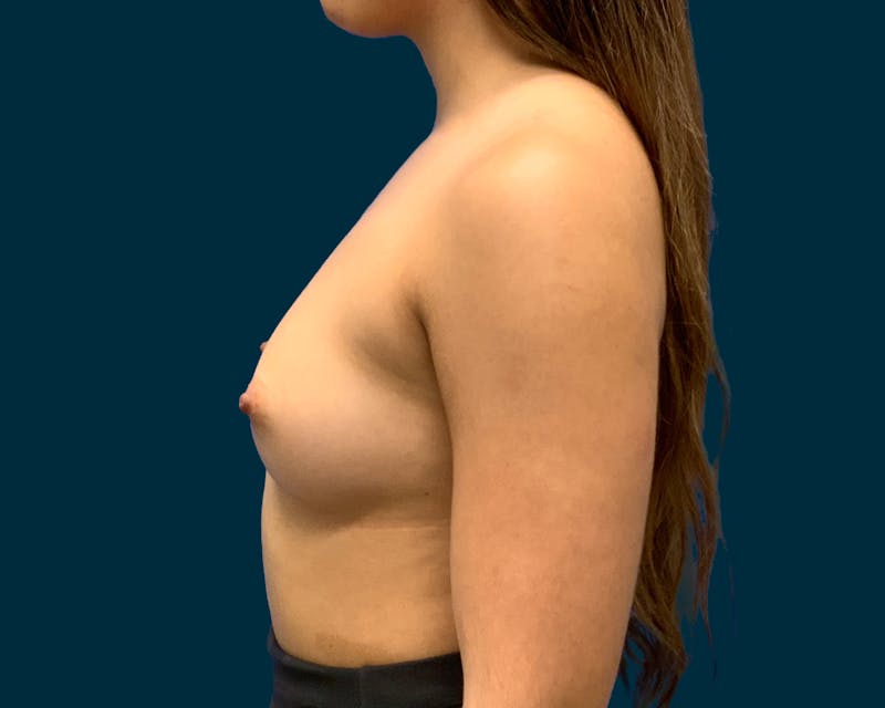 Breast Augmentation Before & After Gallery - Patient 417700 - Image 3