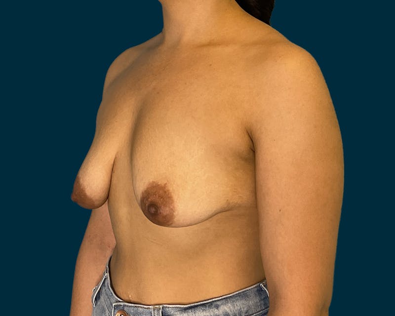 Breast Augmentation Before & After Gallery - Patient 200710 - Image 5