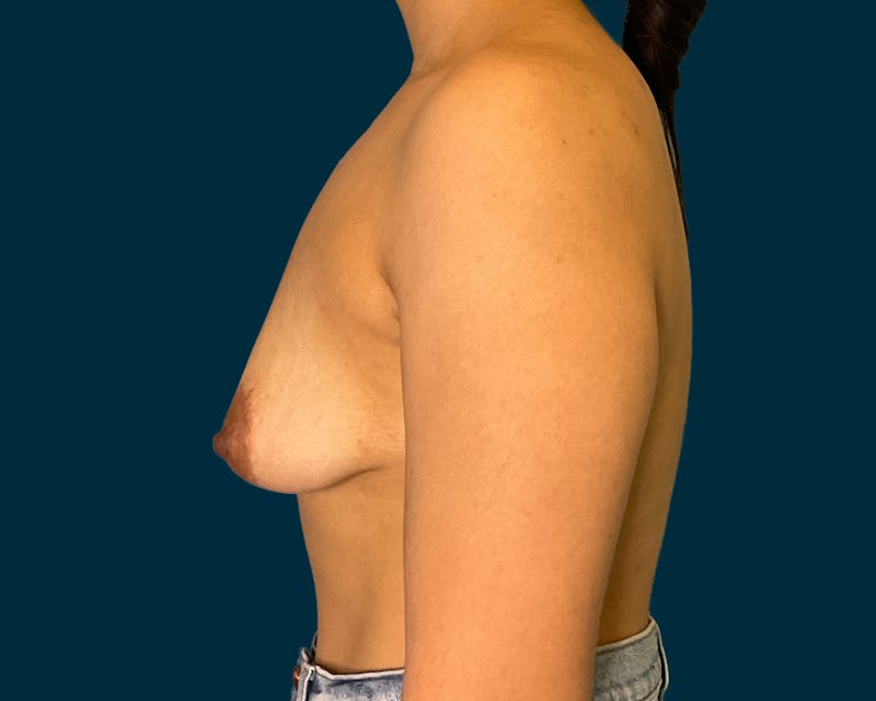 Breast Augmentation Before & After Gallery - Patient 200710 - Image 3