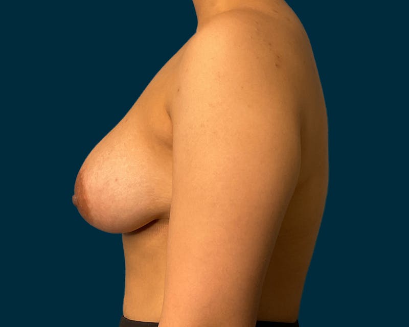 Breast Augmentation Before & After Gallery - Patient 200710 - Image 4