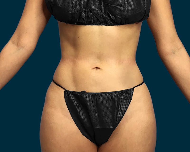 Liposuction Before & After Gallery - Patient 146403 - Image 2