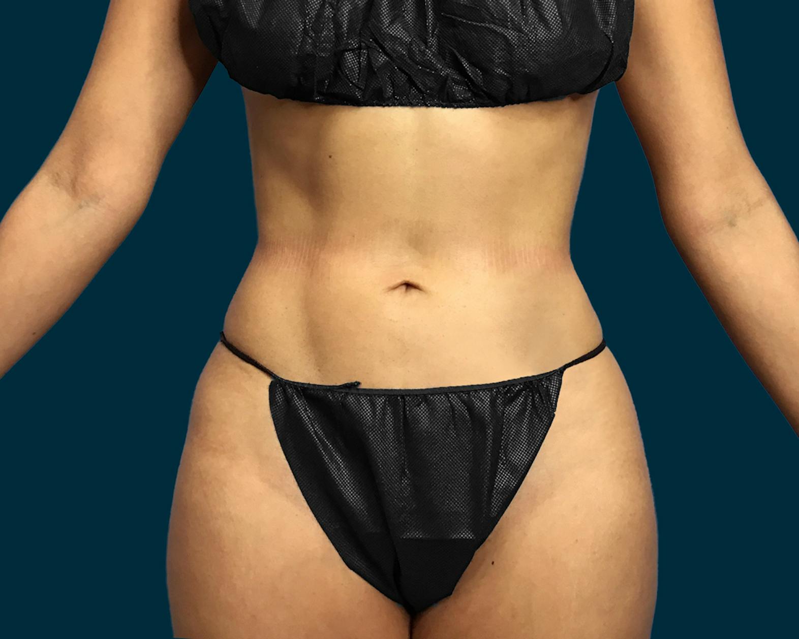 Liposuction patient before media