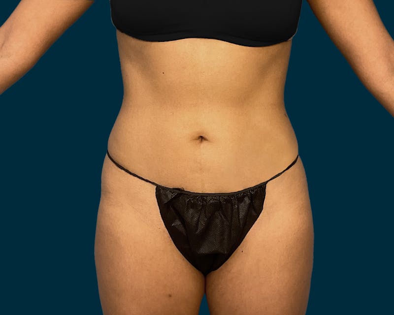 Liposuction Before & After Gallery - Patient 146403 - Image 1