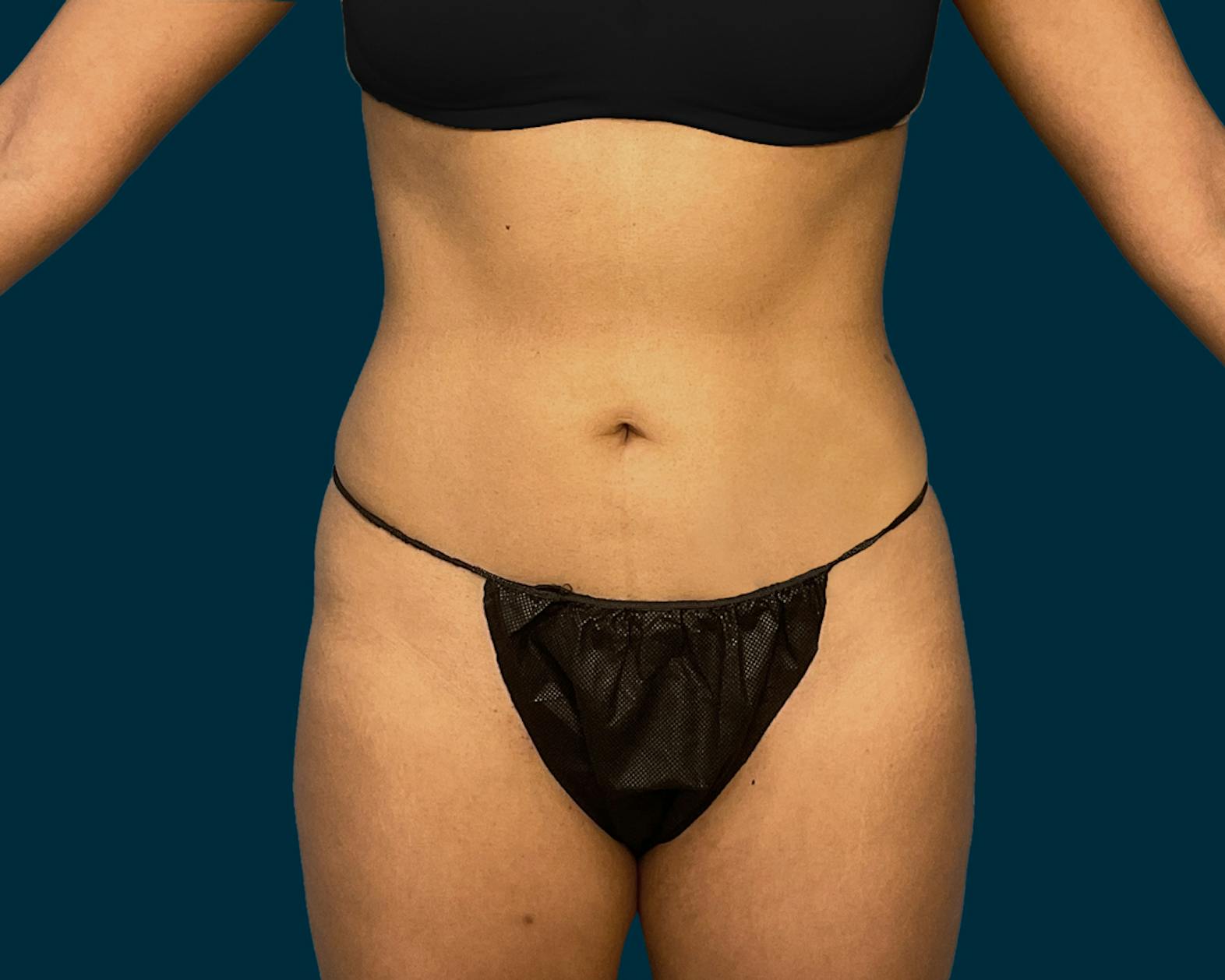 Liposuction patient before media