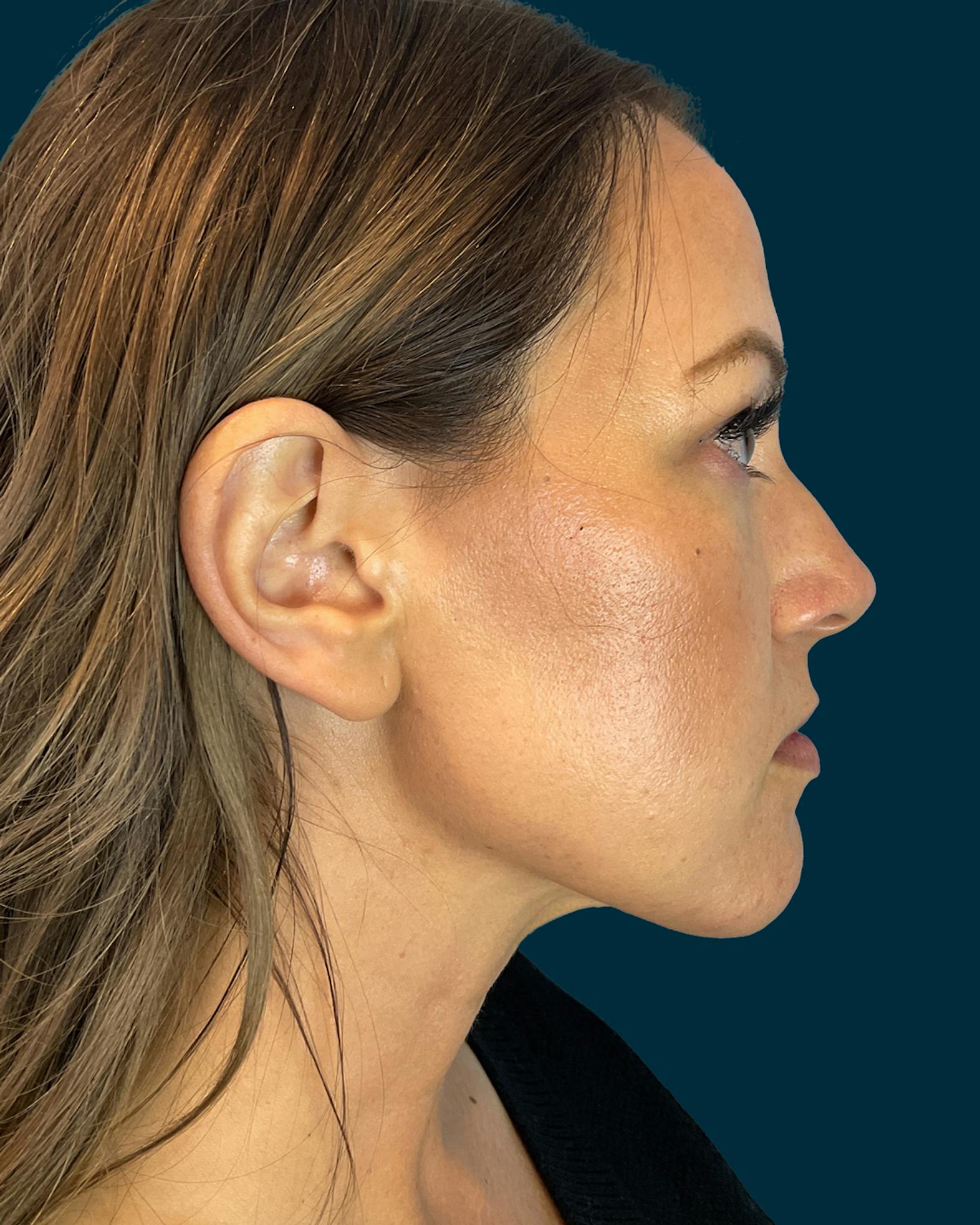 Liposuction patient after media