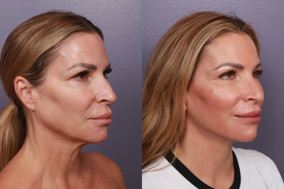 Neck Lift Before & After Gallery - Patient 220593 - Image 3