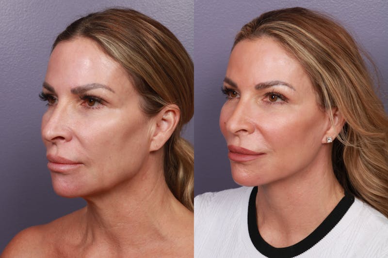 Patient HjhUSV9cSxCmZs9hfAZcnw - Facial Fat Transfer Before & After Photos
