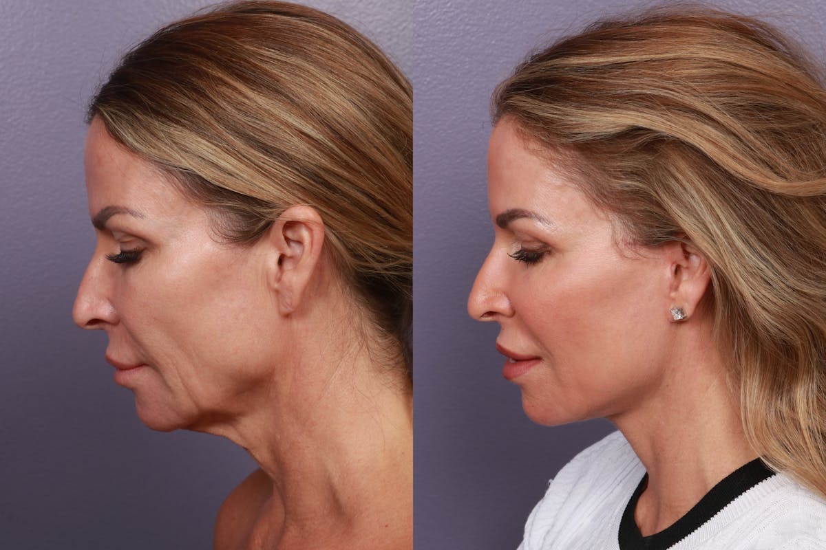 Neck Lift Before & After Gallery - Patient 220593 - Image 1