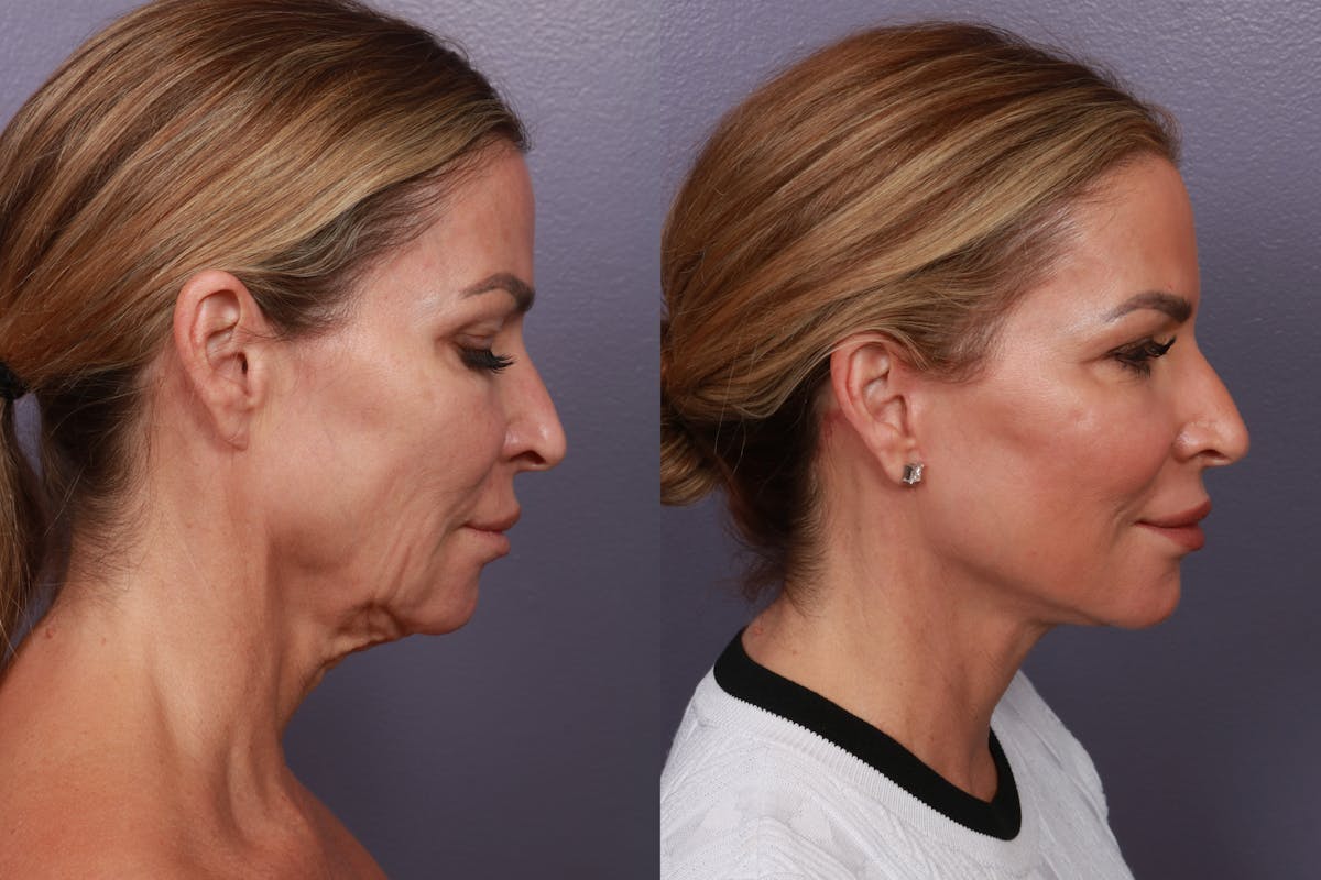Facial Fat Transfer Before & After Gallery - Patient 910006 - Image 4