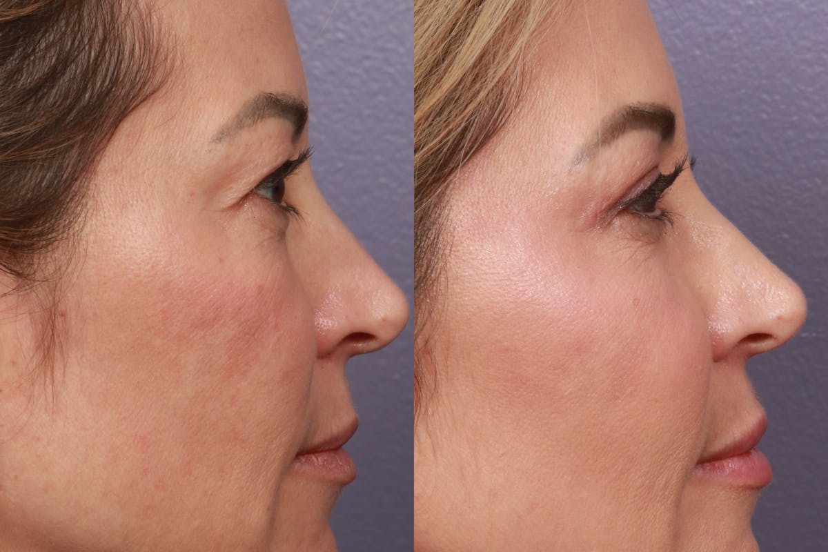 Facial Fat Transfer Before & After Gallery - Patient 214615 - Image 4