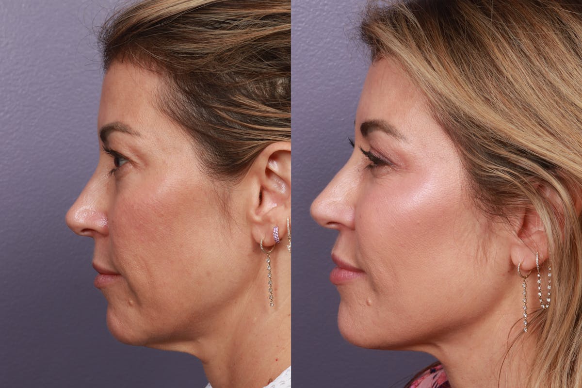Facial Fat Transfer Before & After Gallery - Patient 214615 - Image 2