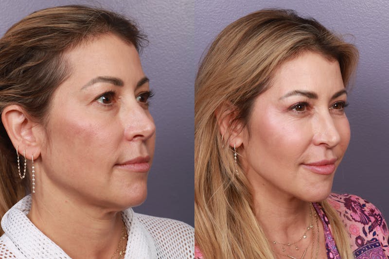 Patient QpboWl1cTyOcWFoKaKYrqg - Facial Fat Transfer Before & After Photos