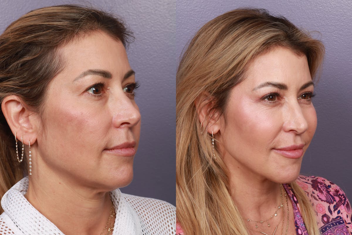 Facial Fat Transfer Before & After Gallery - Patient 214615 - Image 1