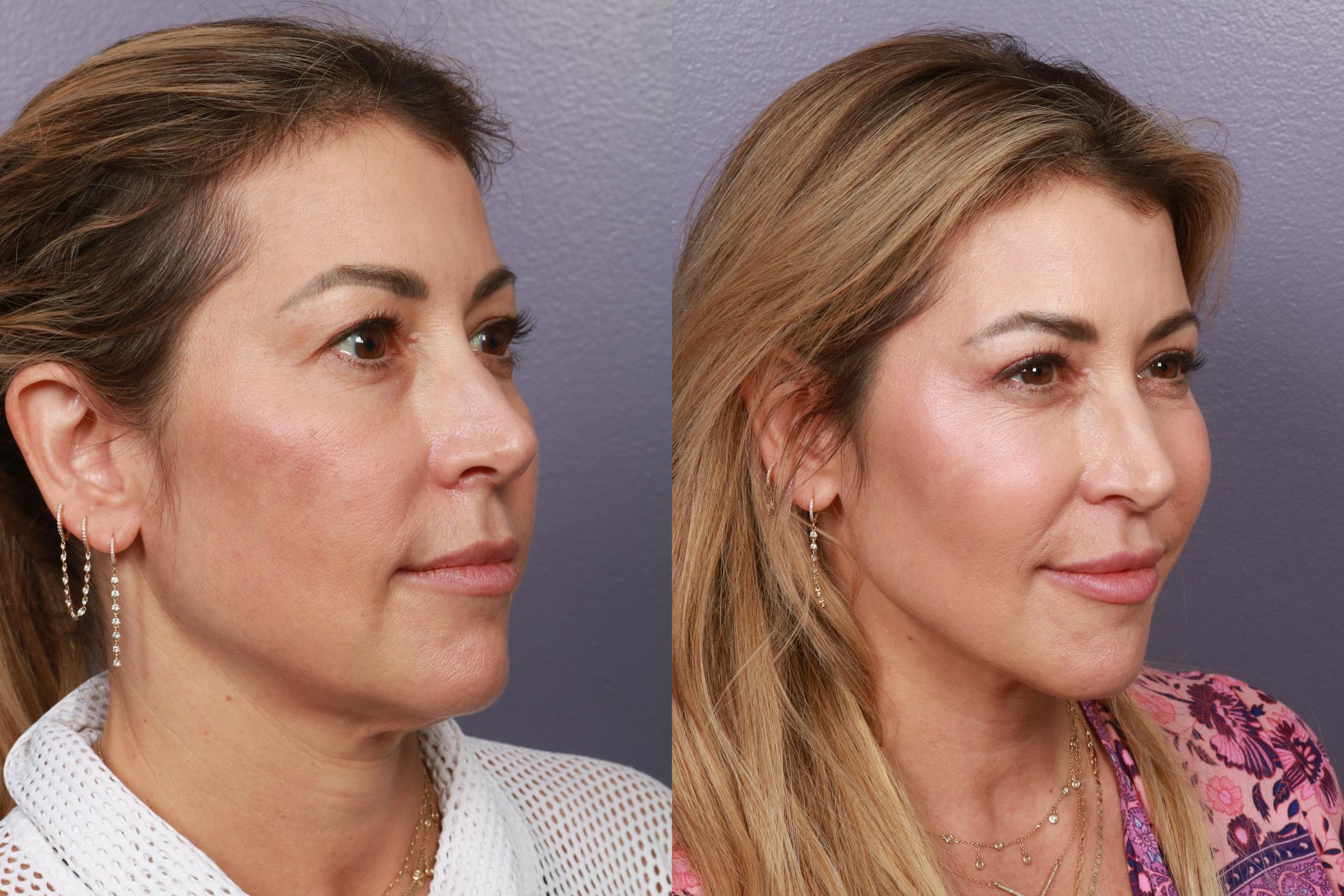 Blepharoplasty Before & After Gallery - Patient 172242 - Image 3