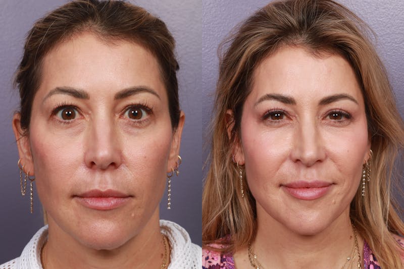 Patient fKaoqRtOT72F5A-0ktviXA - Blepharoplasty Before & After Photos