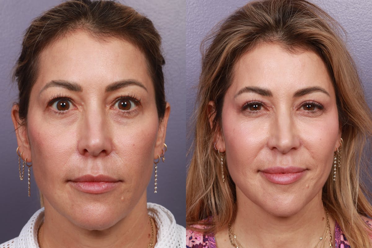 Facial Fat Transfer Before & After Gallery - Patient 214615 - Image 3