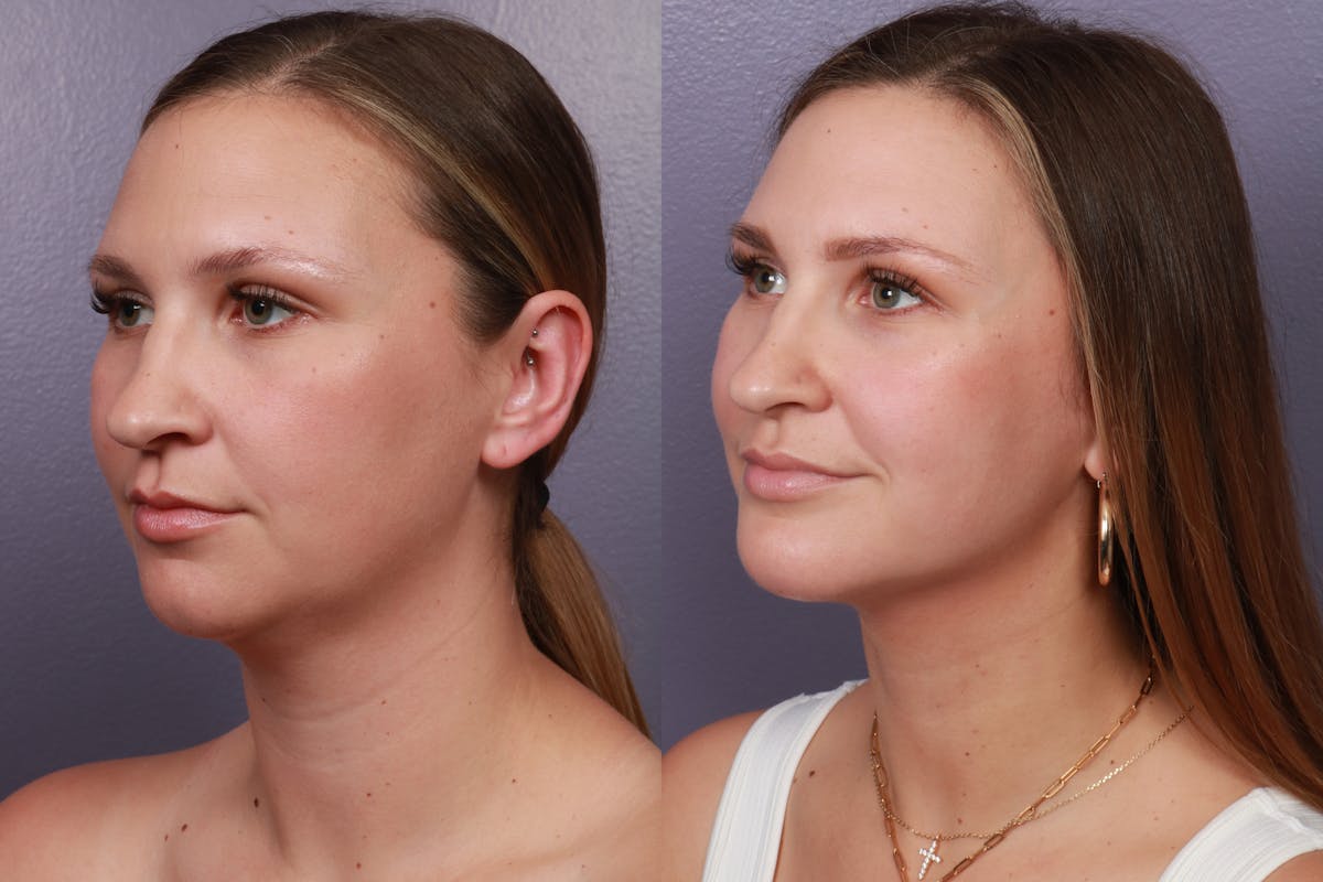 Chin & Neck Liposuction Before & After Gallery - Patient 132511 - Image 2