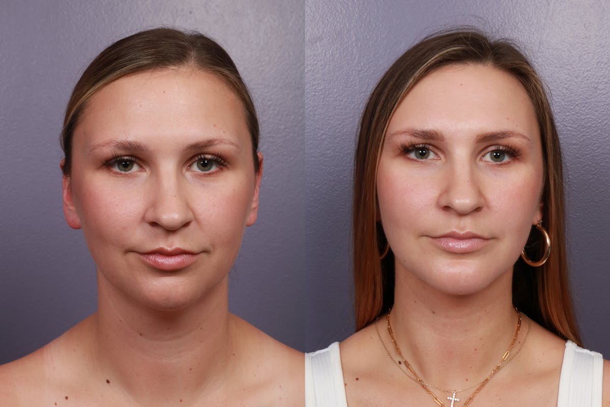 Chin & Neck Liposuction Before & After Gallery - Patient 132511 - Image 3