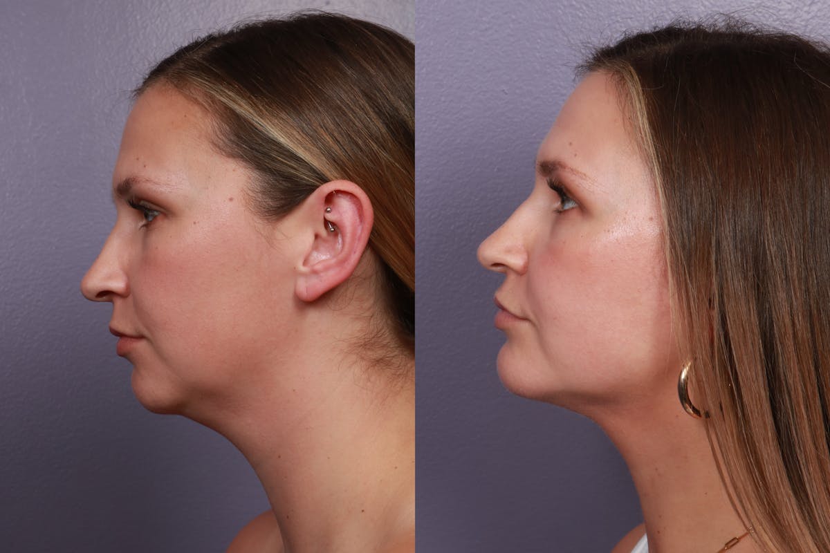 Chin & Neck Liposuction Before & After Gallery - Patient 132511 - Image 1