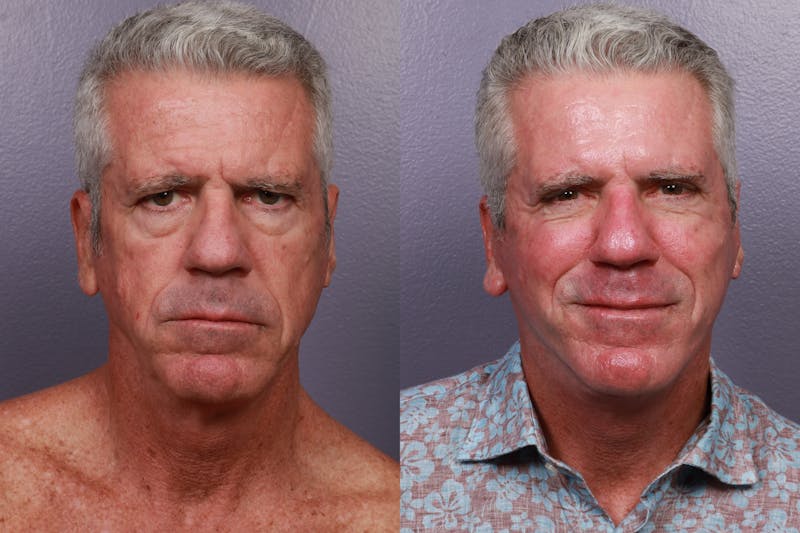 Neck Lift Before & After Gallery - Patient 273907 - Image 1