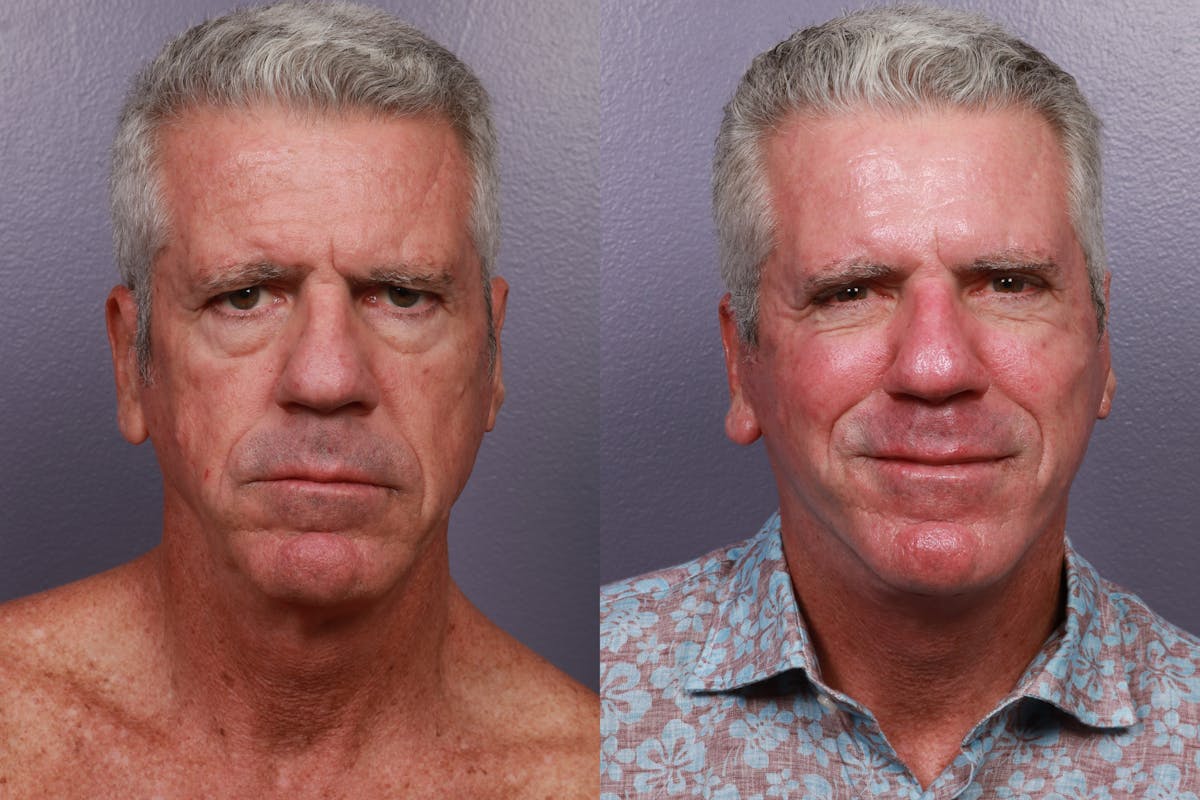Facial Fat Transfer Before & After Gallery - Patient 114313 - Image 2
