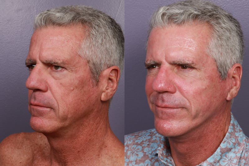 Facial Fat Transfer Before & After Gallery - Patient 114313 - Image 1