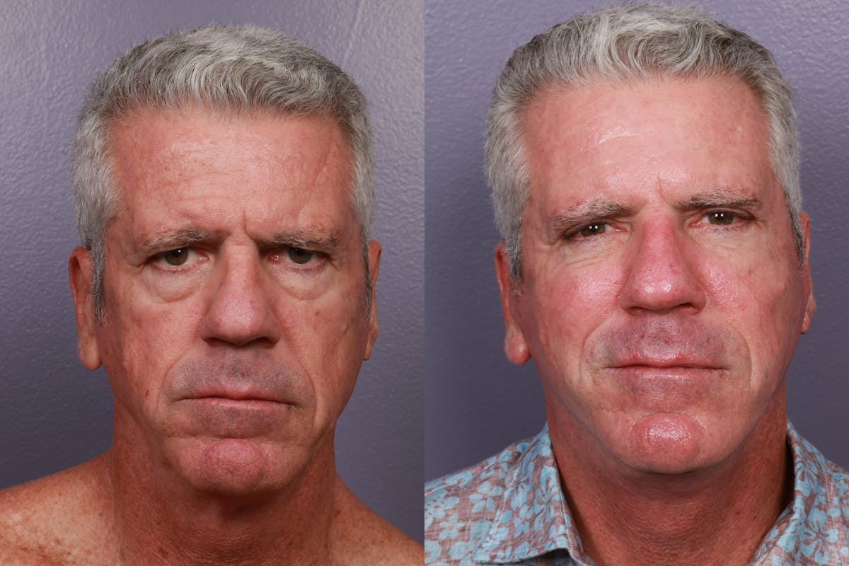 Facial Fat Transfer Before & After Gallery - Patient 114313 - Image 3