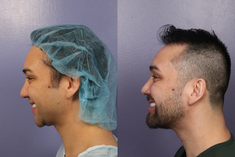 Patient Hvgc6eZSQE2tiL7MxEknFQ - Chin & Neck Liposuction Before & After Photos
