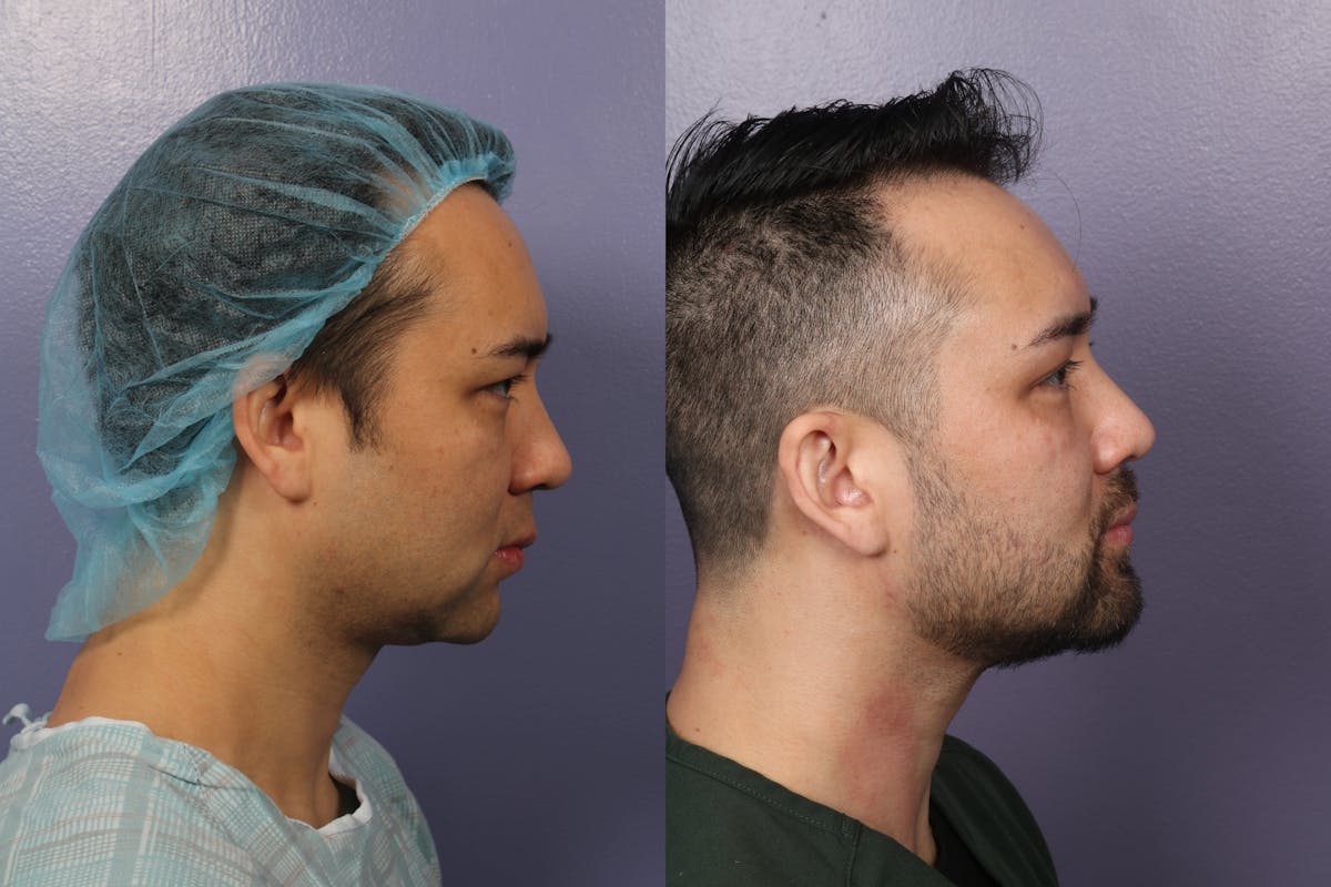 Chin & Neck Liposuction Before & After Gallery - Patient 706660 - Image 4