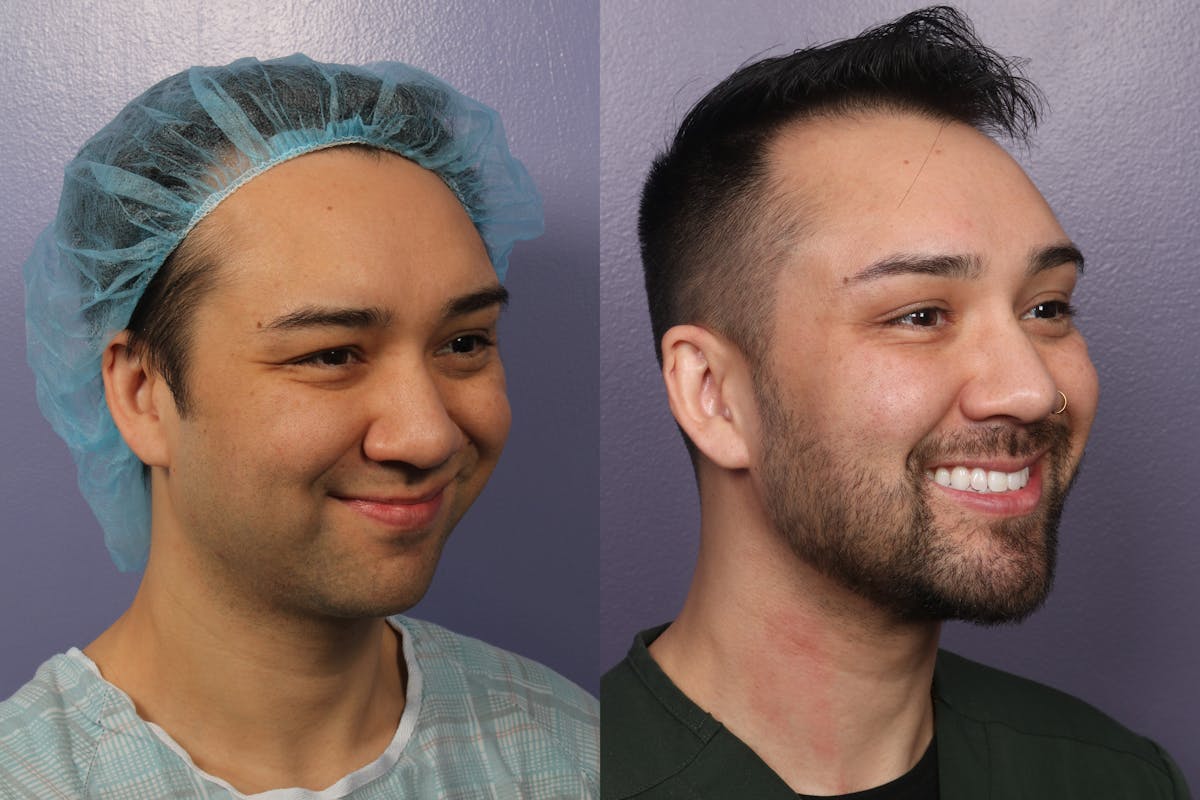 Chin & Neck Liposuction Before & After Gallery - Patient 706660 - Image 2