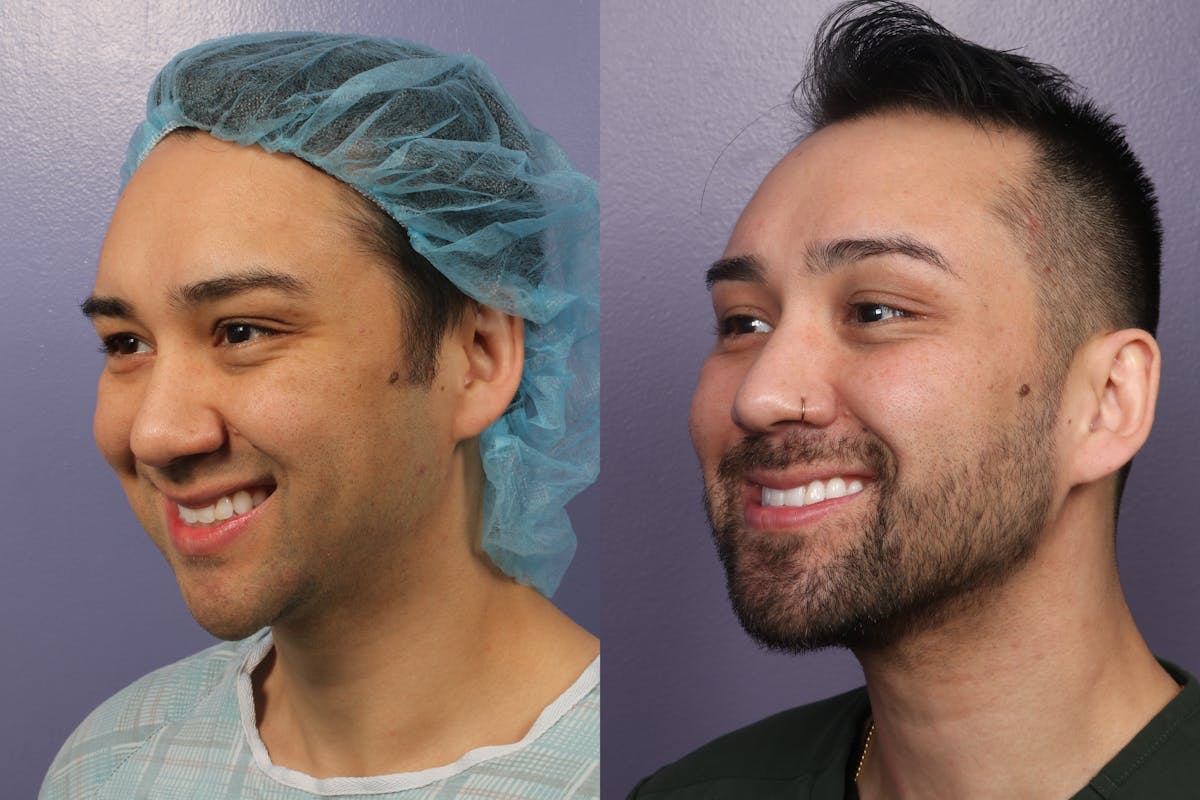 Chin & Neck Liposuction Before & After Gallery - Patient 706660 - Image 5