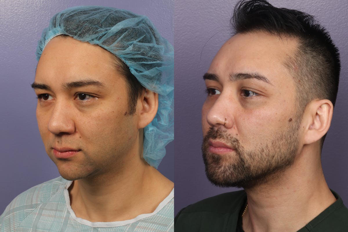 Chin & Neck Liposuction Before & After Gallery - Patient 706660 - Image 6