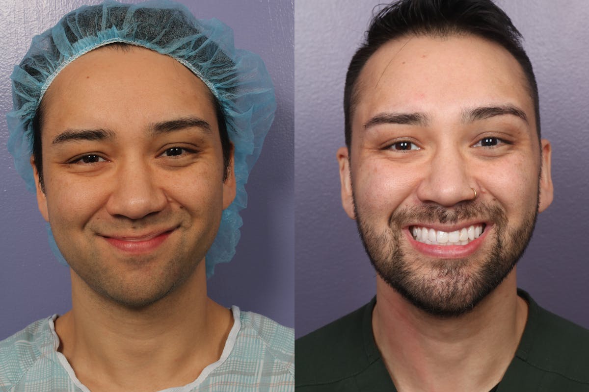 Buccal Fat Removal Before & After Gallery - Patient 204389 - Image 4