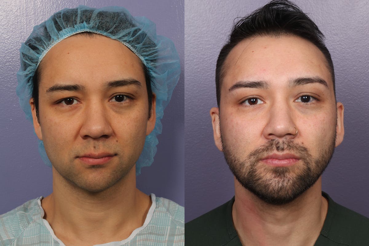 Chin & Neck Liposuction Before & After Gallery - Patient 706660 - Image 7
