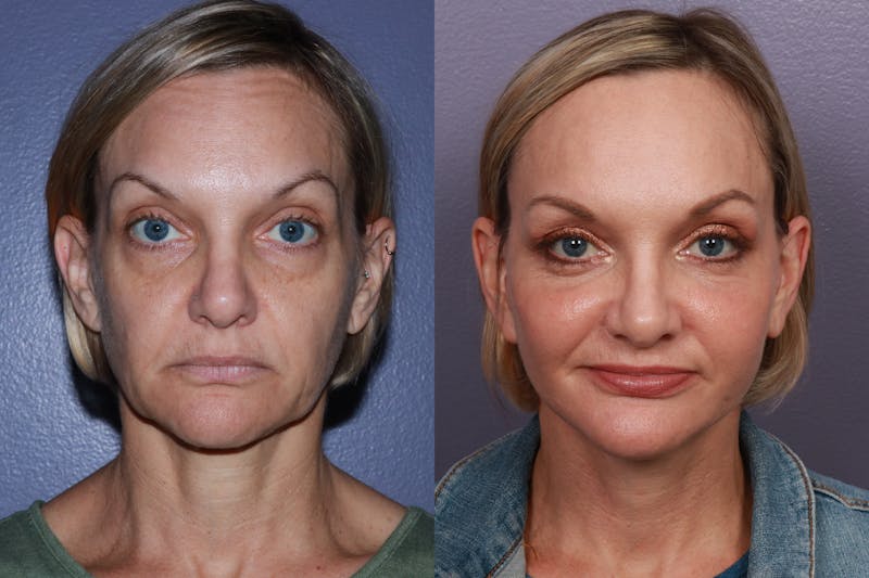 Patient AANhrlyJQ62saVLvBuwwcQ - Blepharoplasty Before & After Photos