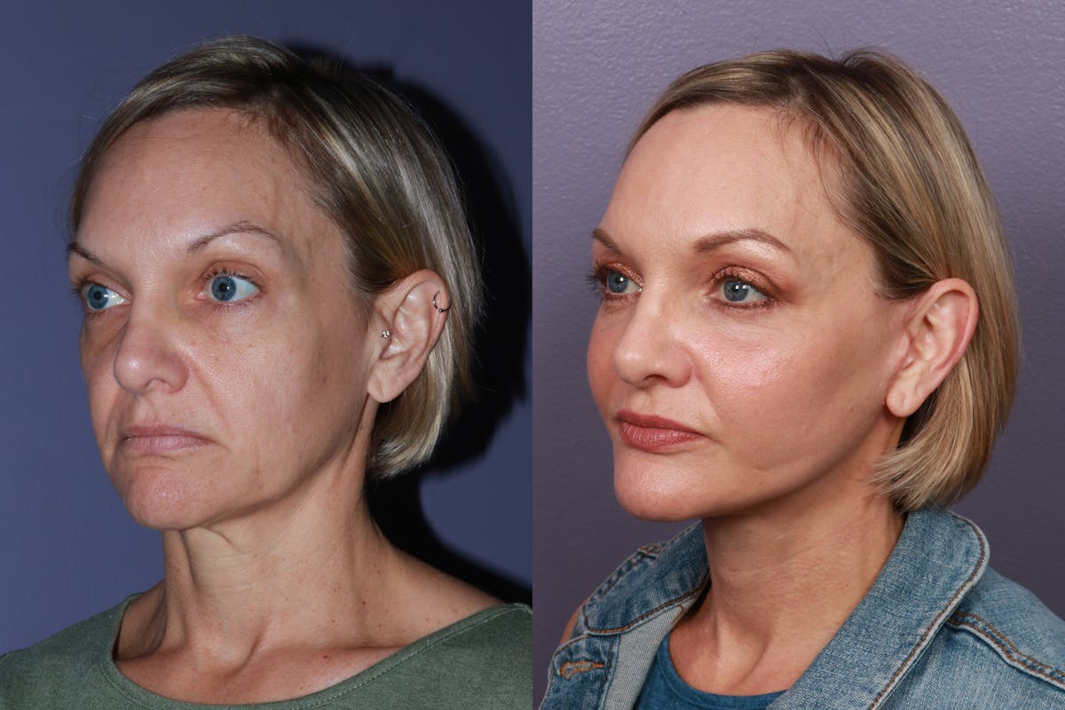 Facial Fat Transfer Before & After Gallery - Patient 220614 - Image 1