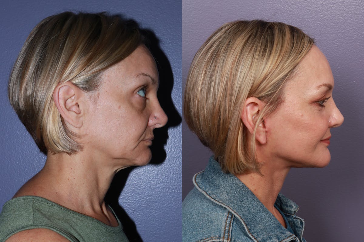Blepharoplasty Before & After Gallery - Patient 521450 - Image 4