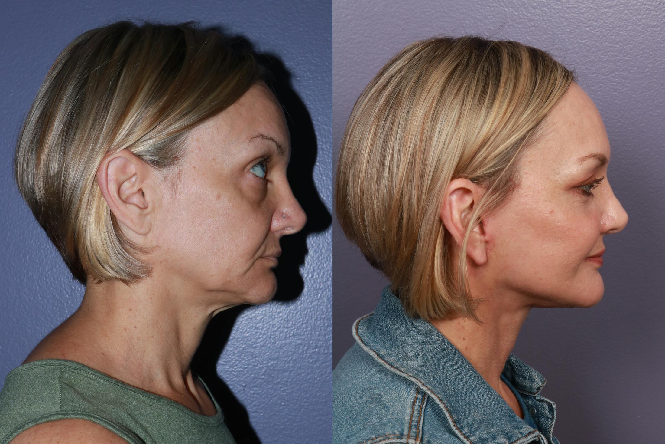 Neck Lift Before & After Gallery - Patient 359382 - Image 4