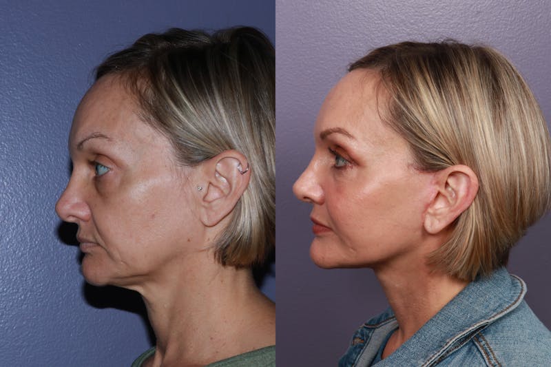 Patient c0AztHnLRfCeUb_0WZKxBg - Neck Lift Before & After Photos