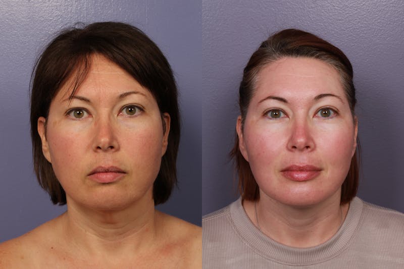 Patient SnpPN303Siandwsfcgil2A - Buccal Fat Removal Before & After Photos
