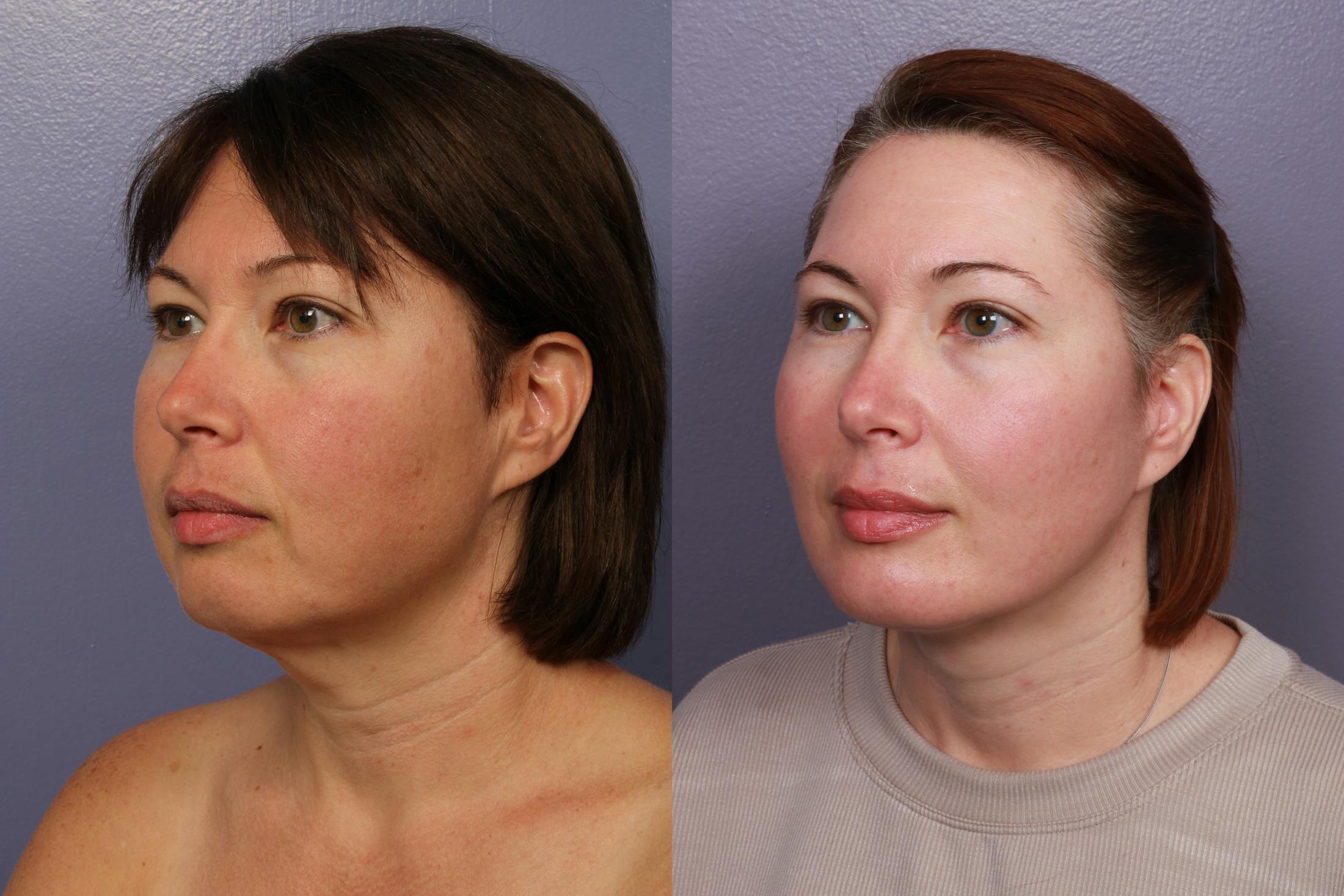 Buccal Fat Removal Before & After Gallery - Patient 264403 - Image 3