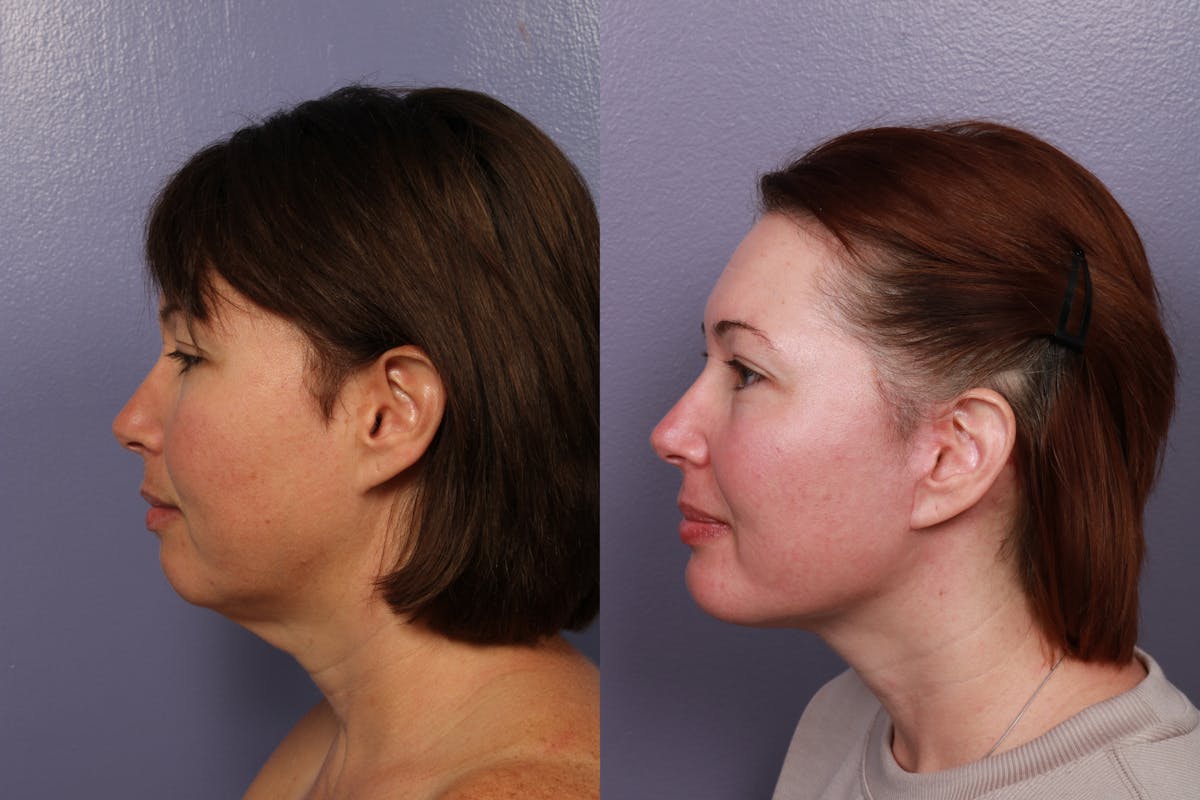 Buccal Fat Removal Before & After Gallery - Patient 264403 - Image 2