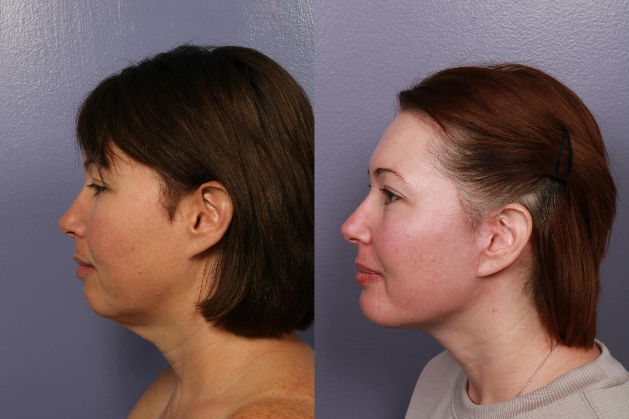 Buccal Fat Removal Before & After Gallery - Patient 264403 - Image 2