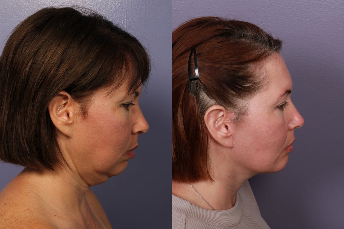 Facelift Before & After Gallery - Patient 296323 - Image 4