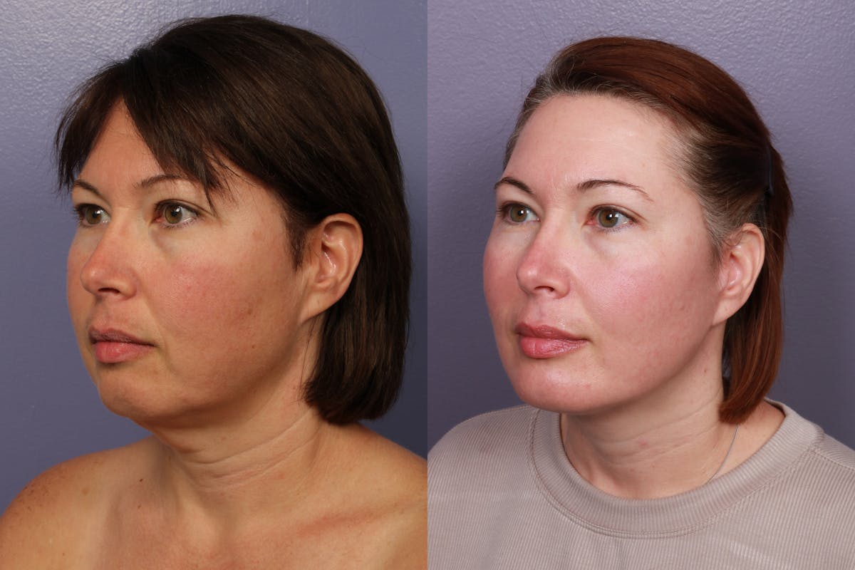Facelift Before & After Gallery - Patient 296323 - Image 5